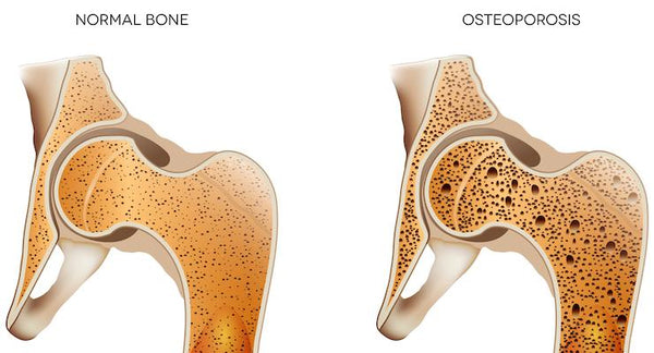 How strong and healthy are your bones? | Mr Vitamins