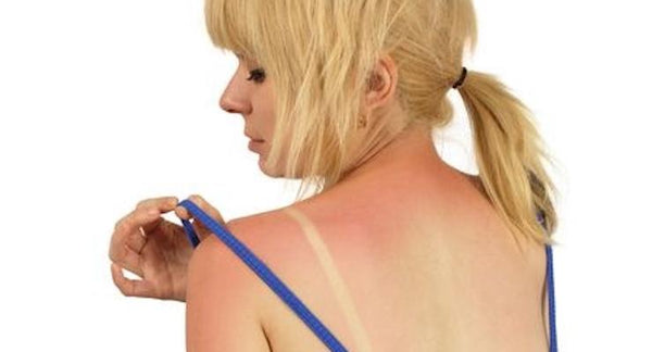 How to soothe your sunburnt damaged skin | Mr Vitamins