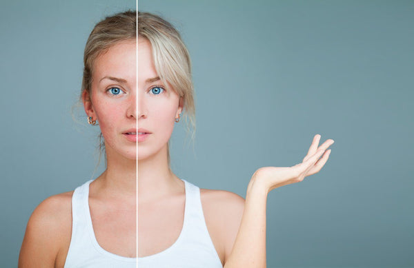 Rosacea: When it’s more than just a rosey glow | Mr Vitamins